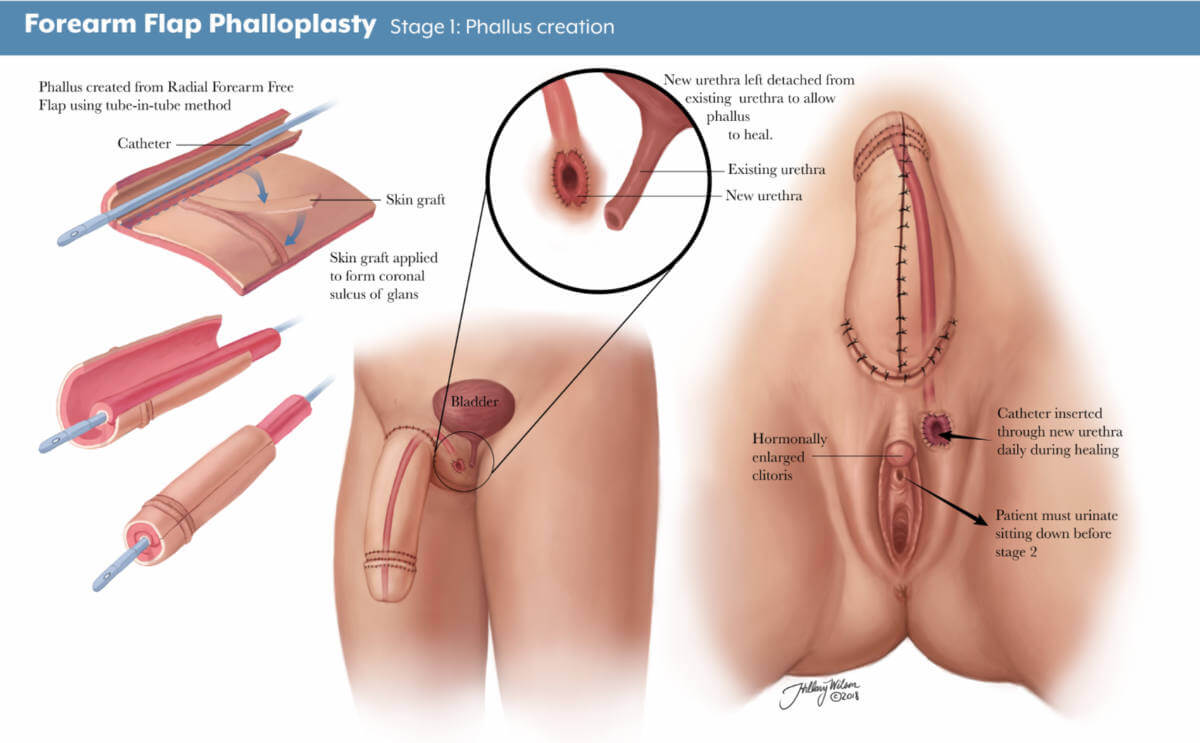 Hillary Wilson's illustrations of gender affirming surgery detailing phalloplasty phallus creation.