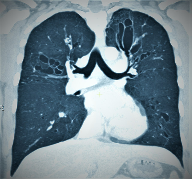 imaging copy of nontuberculous mycobacteria-infected lung