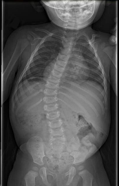 Infantile Idiopathic Scoliosis Johns Hopkins Medicine Health Library