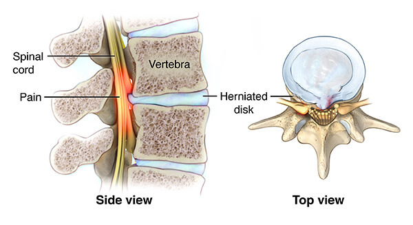 Myelopathy | Johns Hopkins Medicine Health Library