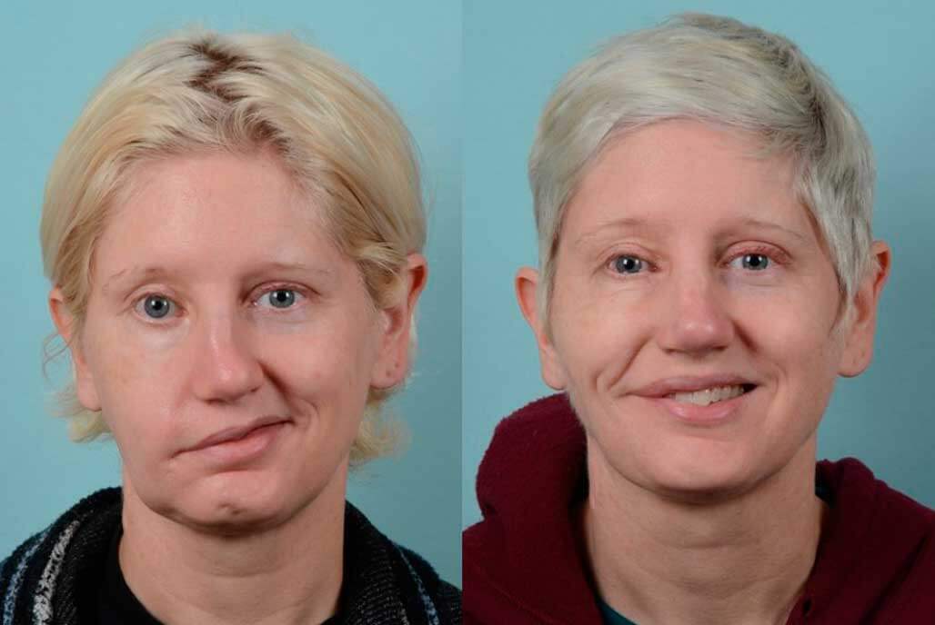 Facial surgery trama