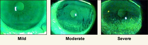 rheumatoid arthritis eyes