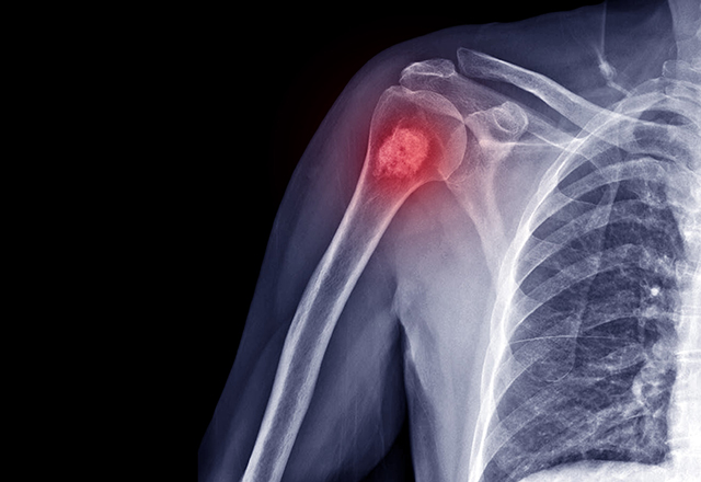 shoulder pain x-ray