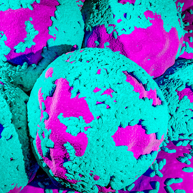Illustration of a cancer cell in an ovarian cyst shows several bright purple spheres partially covered in teal masses.