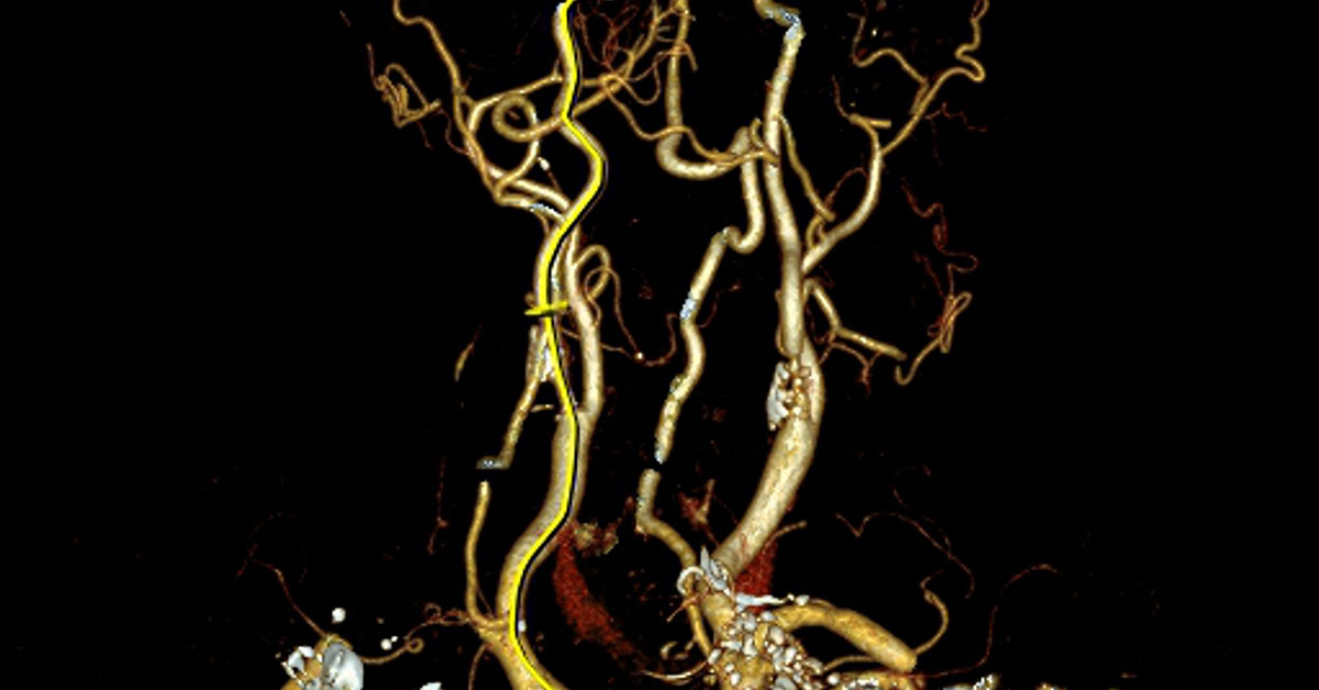 A Full Complement Of Care For Patients With Carotid Artery Disease Johns Hopkins Medicine 4179