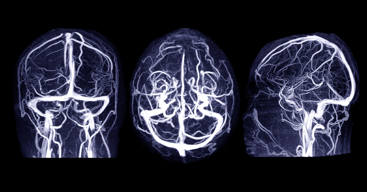 Early, Intense Rehabilitation for Stroke Recovery | Johns Hopkins Medicine