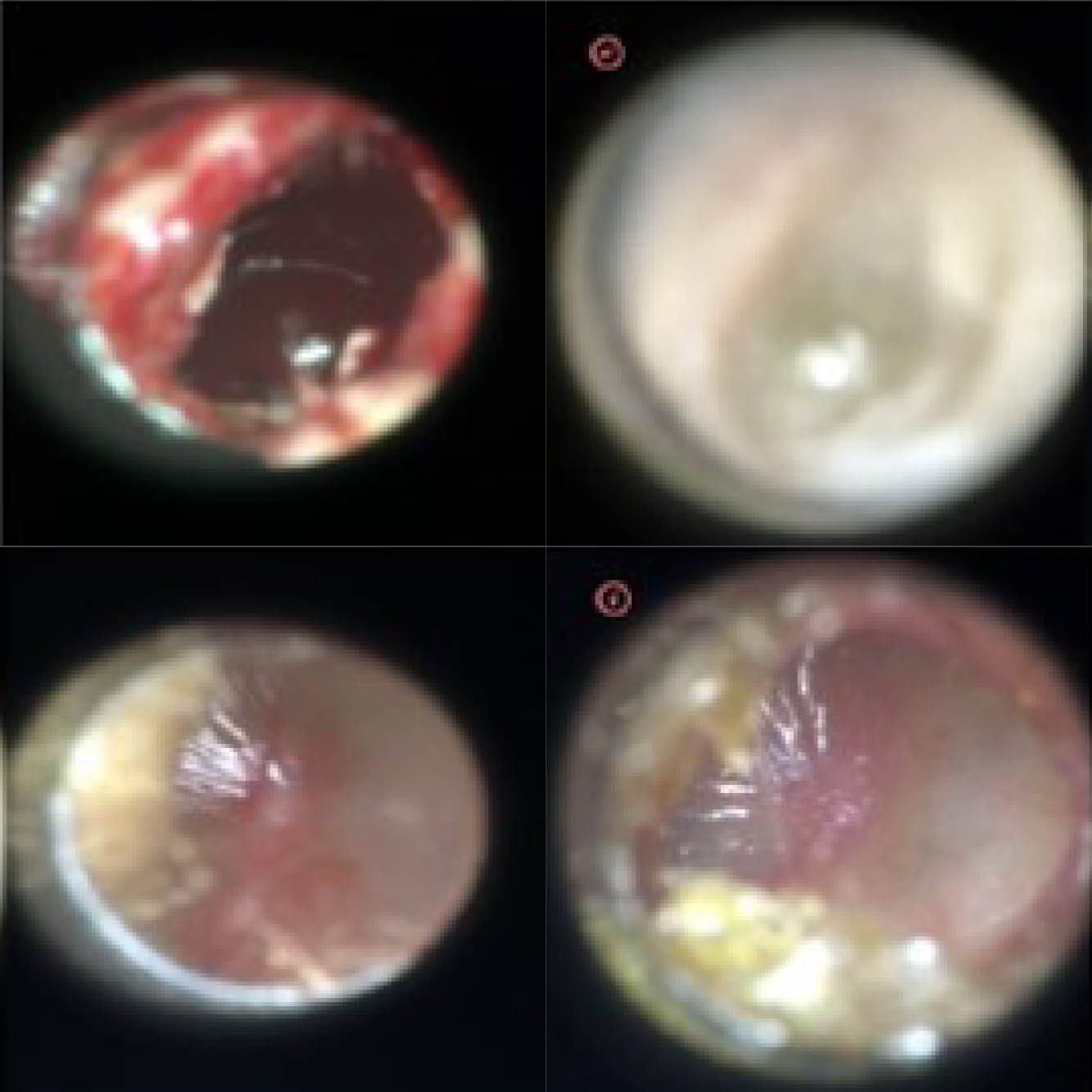 otoscope view ear infection