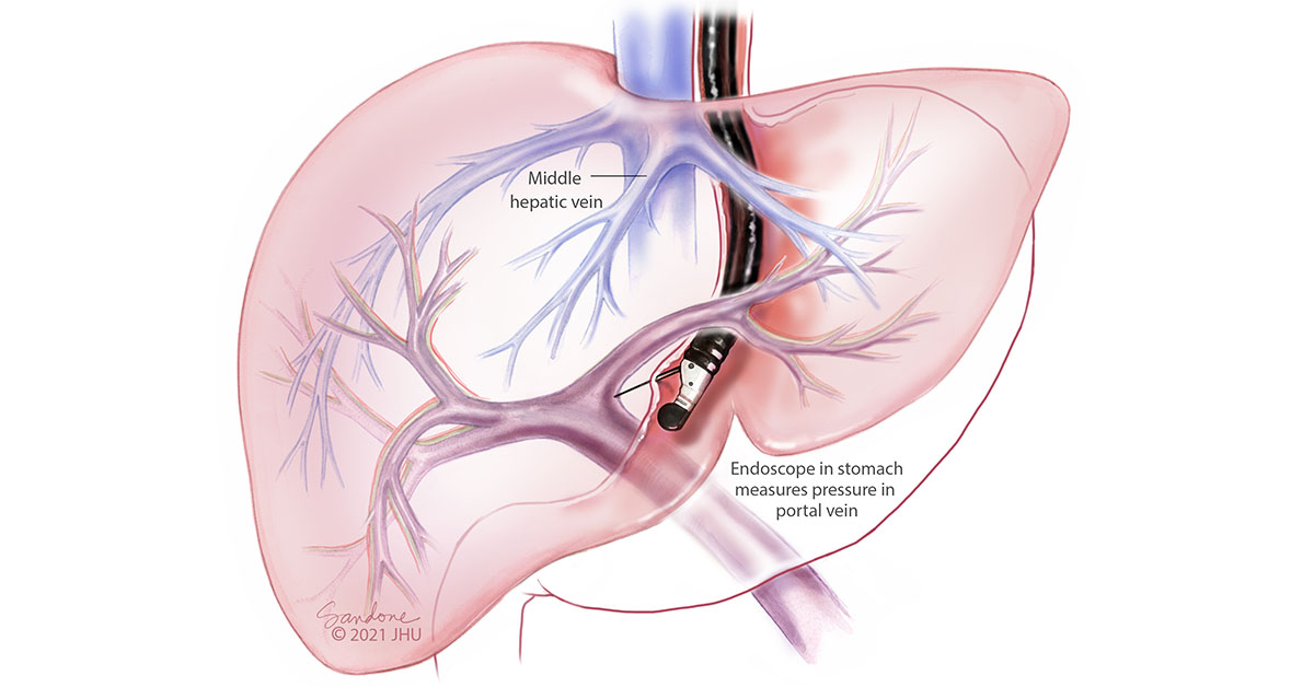 endoscopic-ultrasound-measures-pressure-in-hepatic-portal-vein-johns