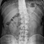 Two x-ray images show spine curvature indicating scoliosis