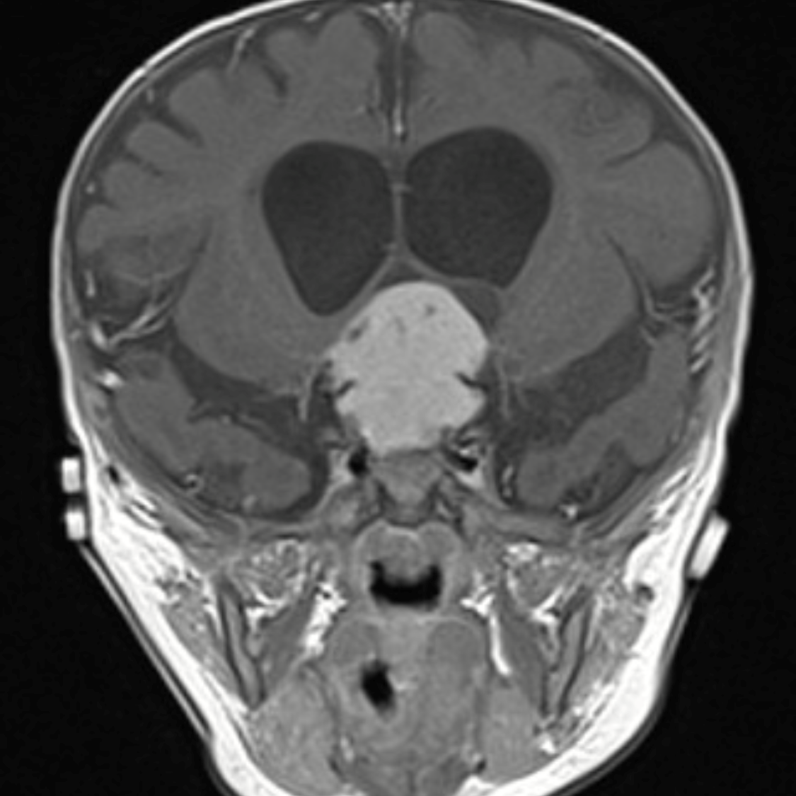 Image Of The Month: Brain Tumors Reclassified | Johns Hopkins Medicine