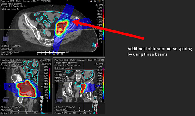 proton therapy case 3