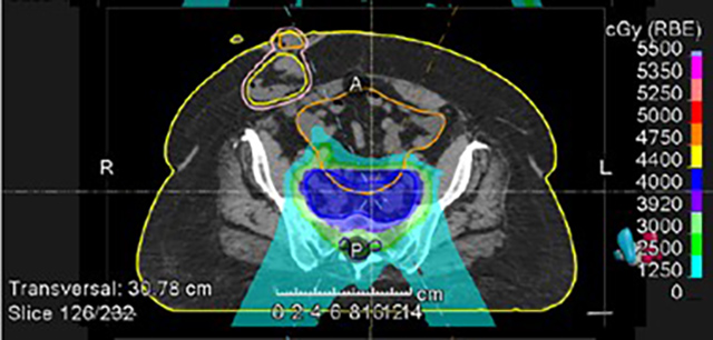 great ostomy stoma sparing