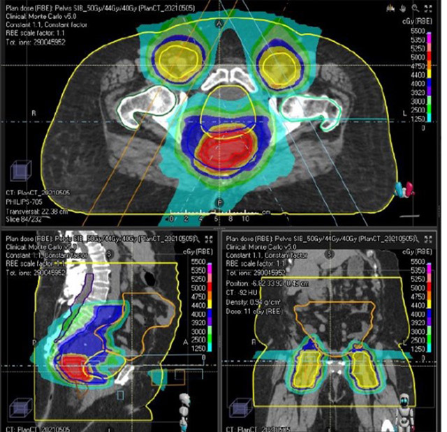 radiation field case study 62