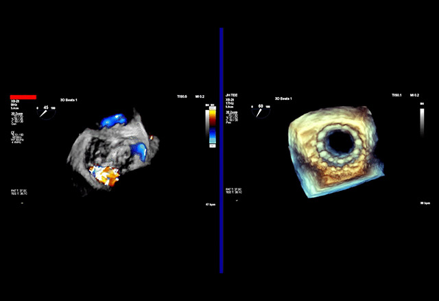 Continuous loop video shows pre- and post- transcatheter mitral valve replacement (TMVR)