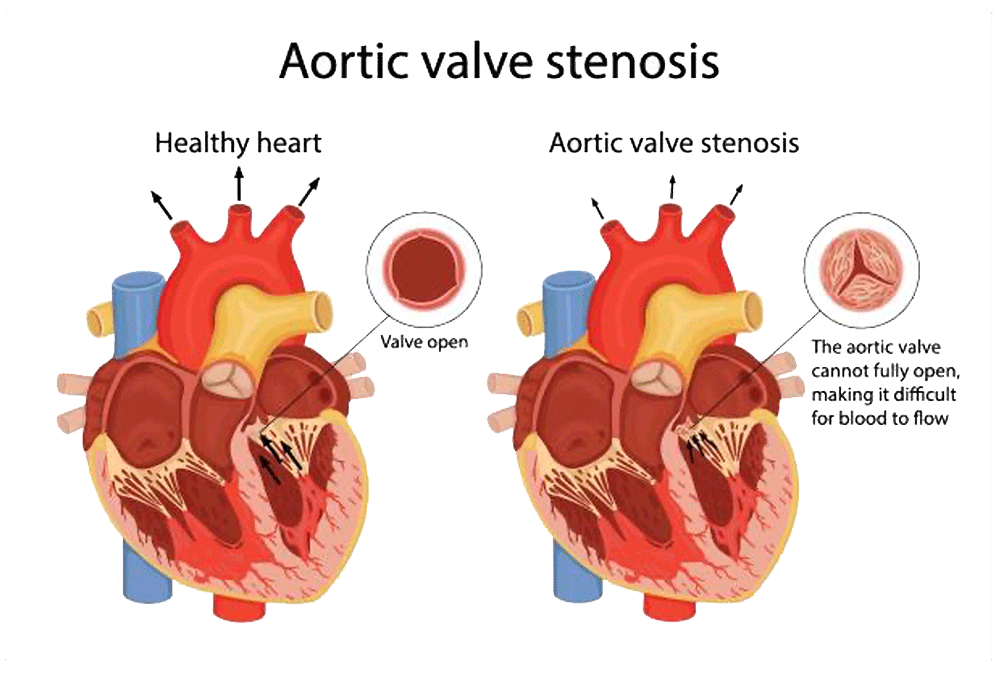 Aortic valve stenosis illustration