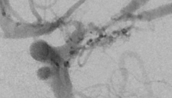 angiogram of moyamoya