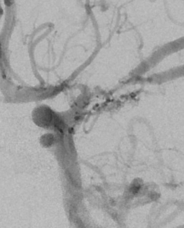 angiogram of moyamoya