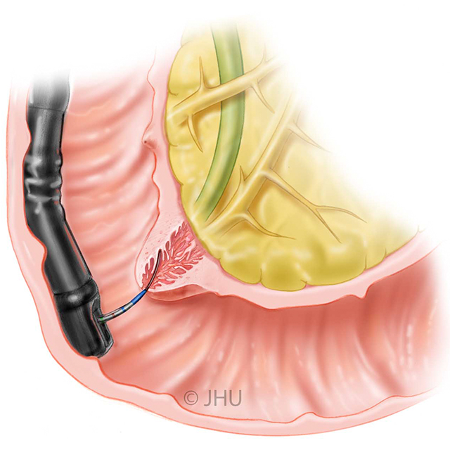 A medical illustration of Endoscopic retrograde cholangiopancreatography (ERCP)