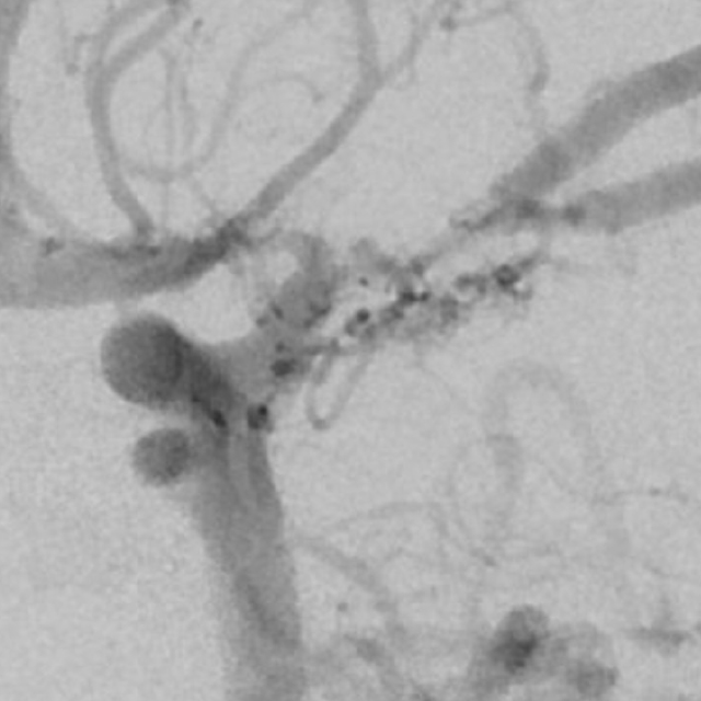 An angiogram shows a classic case of moyamoya.