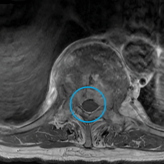 An axial MRI image shows a tumor in the patient’s T10 vertebrae and spinal canal.