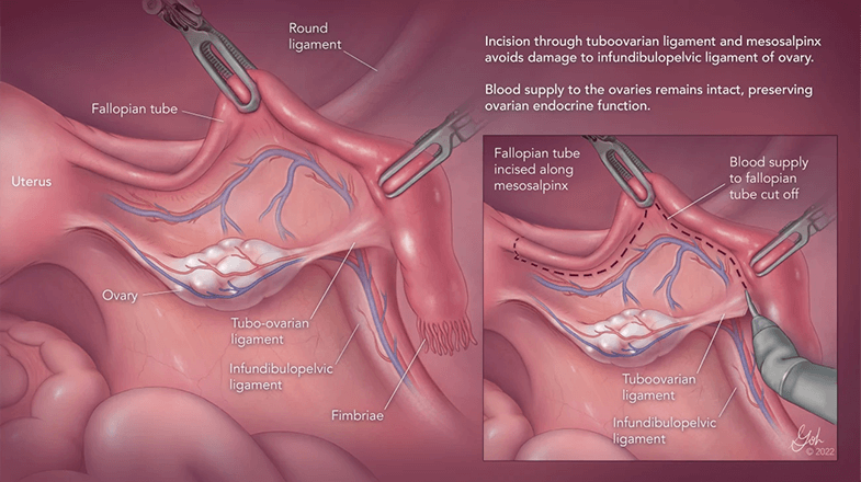 Illustration of a salpingectomy by Gyyoung Oh, Johns Hopkins University School of Medicine