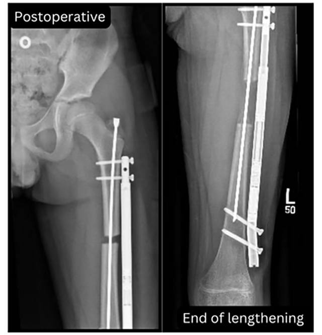 pediatric limb deformity reconstruction before and after