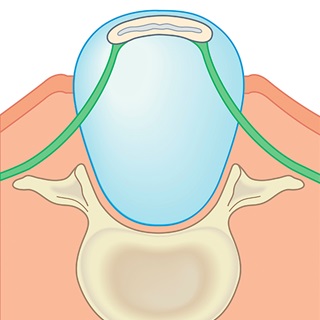 A digital illustration shows myelomeningocele, the most severe form of spina bifida.  