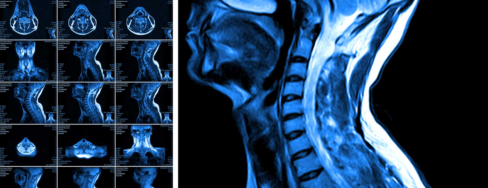 Cervical Myelopathy Johns Hopkins Medicine