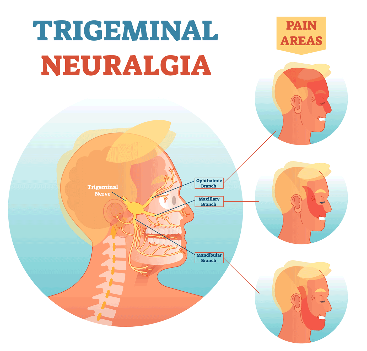 trigeminal neuralgia trigger points