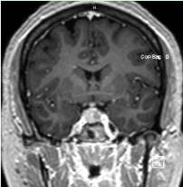 Pituitary Tumors Johns Hopkins Medicine