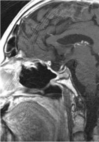 Pituitary Adenoma Johns Hopkins Medicine