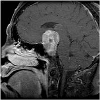 Pituitary Adenoma | Johns Hopkins Medicine