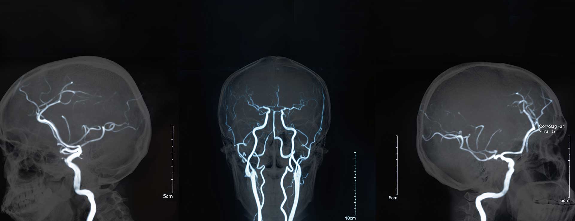 Life Expectancy After Unruptured Aneurysm Coiling - Cher Washburn