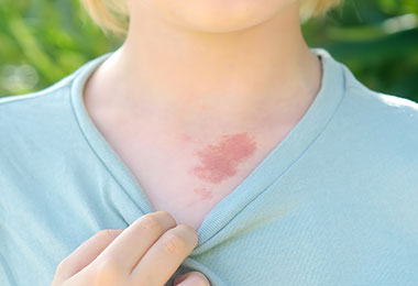 child pulls the collar of their shirt down to reveal a birthmark