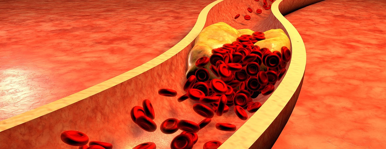 illustration of cholesterol build-up