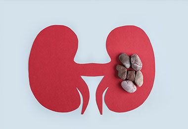 Rocks on top of an illustration of kidneys, representing kidney stones