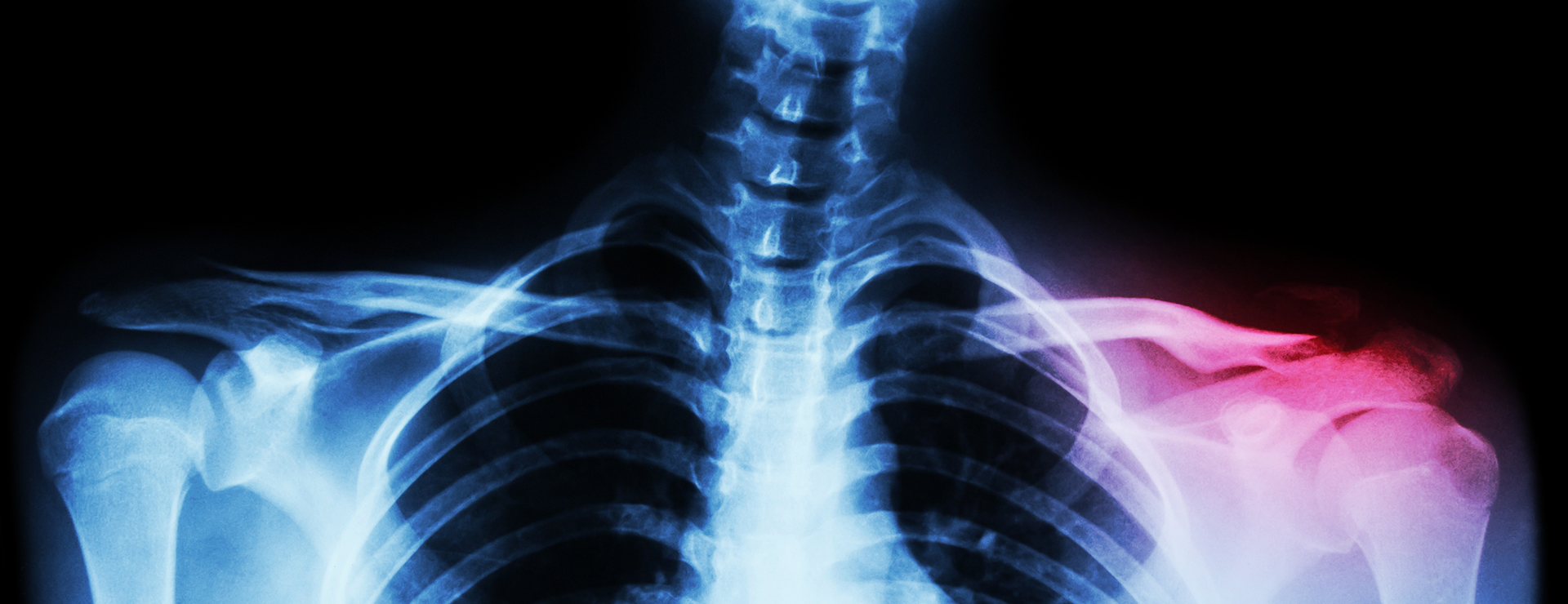 Clavicle Fractures | Johns Hopkins Medicine