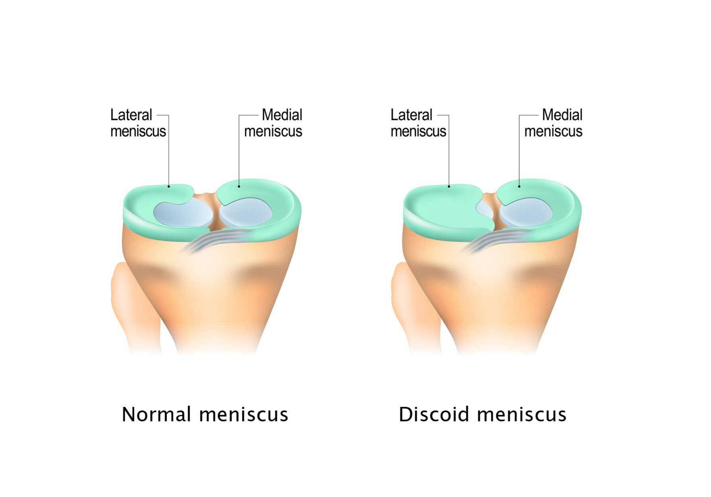 Illustration of a normal meniscus next to a discoid meniscus