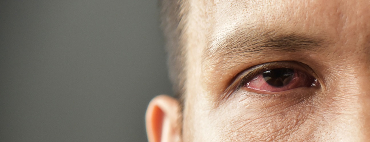 Pink eye: What it is and how to treat it