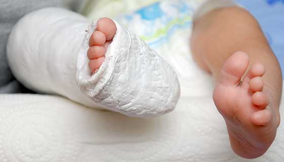 Have you noticed that your newborn baby's feet are turned in