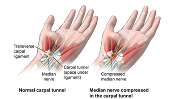 Feeling a Tingling Sensation in Your Hand or Wrist That Won't Go Away? It  Could Be a Sign of Carpal Tunnel Syndrome