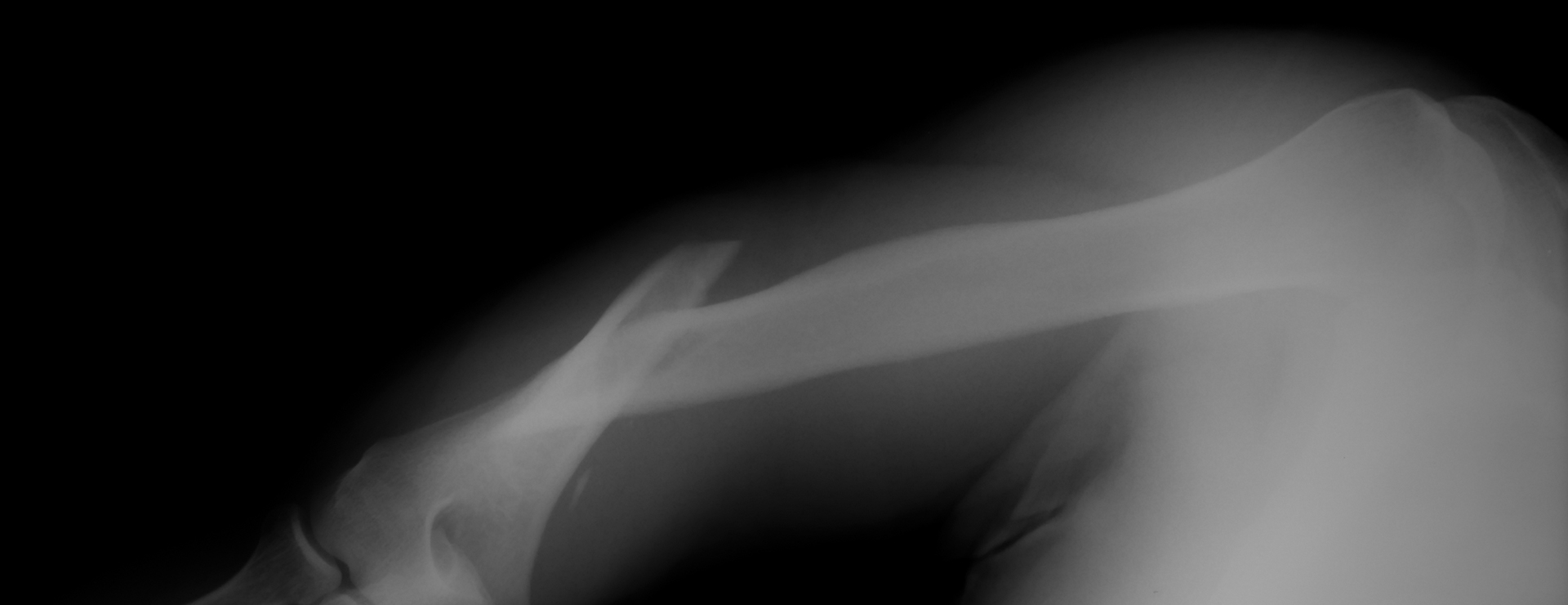 Humerus Fracture Upper Arm Fracture Johns Hopkins Medicine