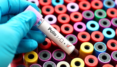A blood sample positive for polio virus