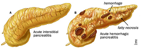 Acute Pancreatitis Johns Hopkins Medicine