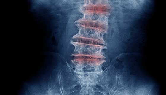 Chronic Back Pain Is A Sign Of Spinal Stenosis: Know Causes, Symptoms,  Treatment and More