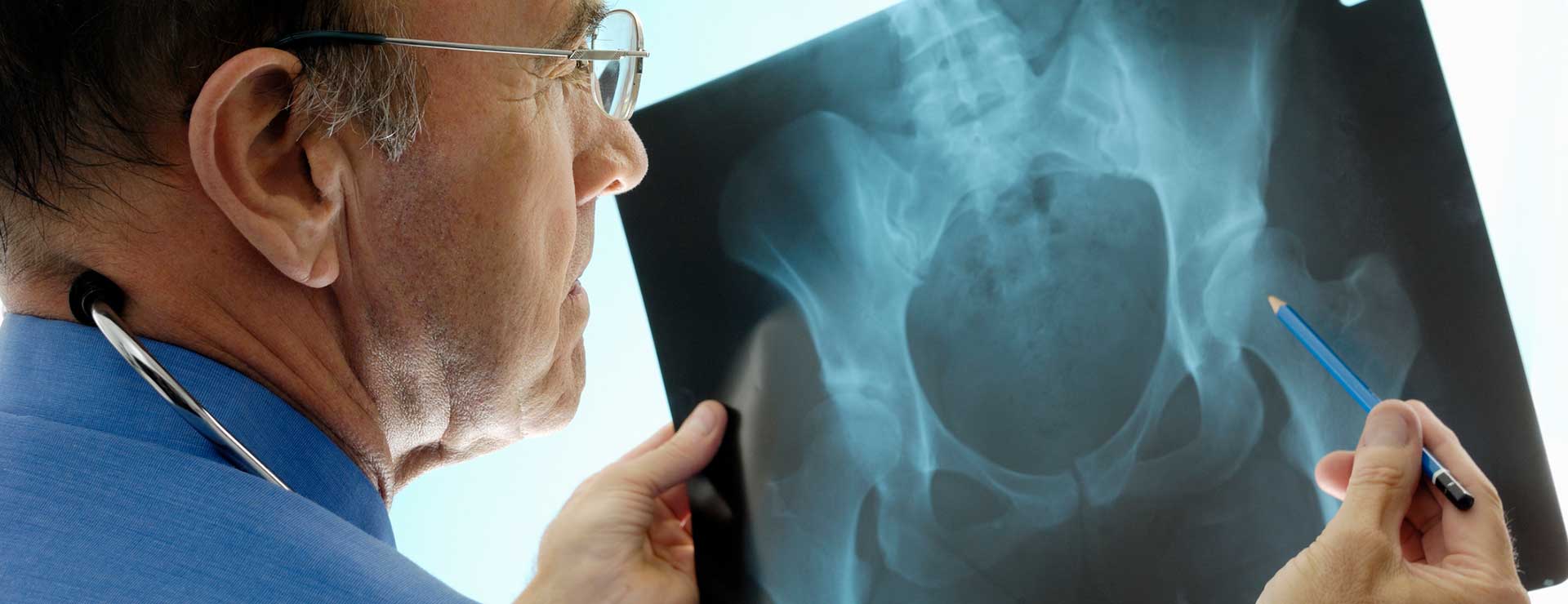 Osteoporosis What You Need to Know as You Age Johns Hopkins