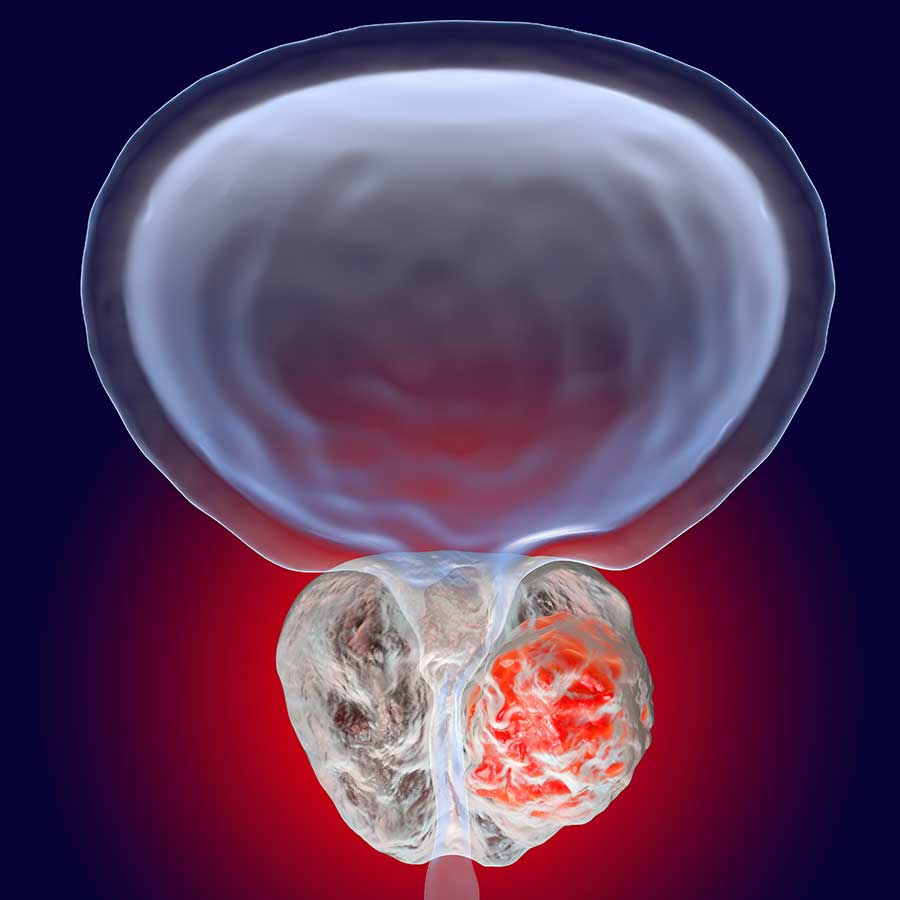 Prostate Cancer Diagnosis Johns Hopkins Medicine