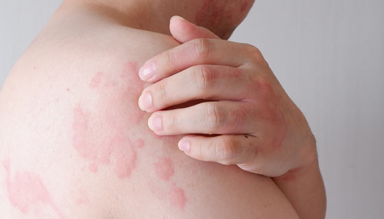 Drug Rashes | Johns Hopkins Medicine