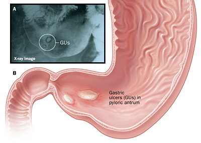 Peptic Ulcer Disease | Johns Hopkins Medicine