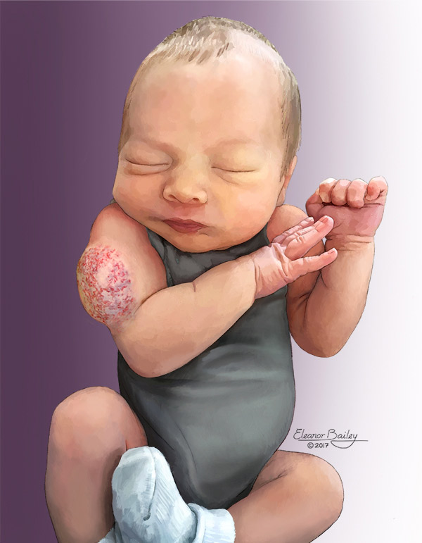 Congenital Hemangioma | Johns Hopkins Medicine